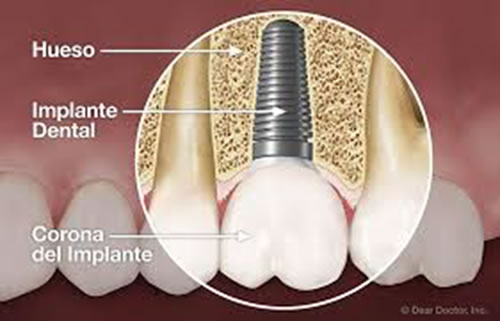 implantes